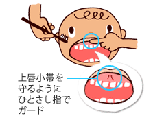 上唇小帯を守るようにひとさし指でガード